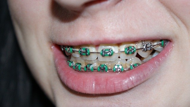 tooth, dental braces, bite tooth, dental braces, bite