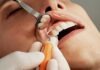 What Are Veneers, And When Would I Need Them?