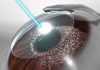 What Is Lasik Eye Surgery & How Much Does It Cost in NYC?
